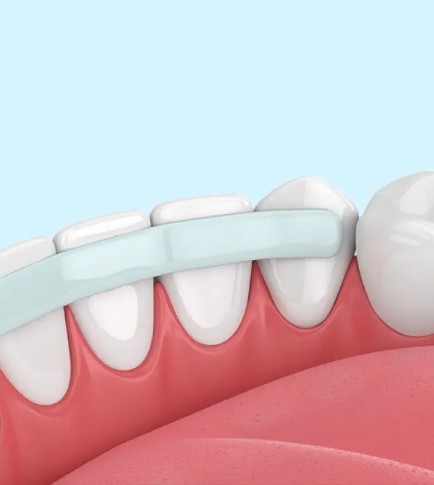 Dental bonding procedure showing tooth-colored resin applied to front teeth with a light applicator.
