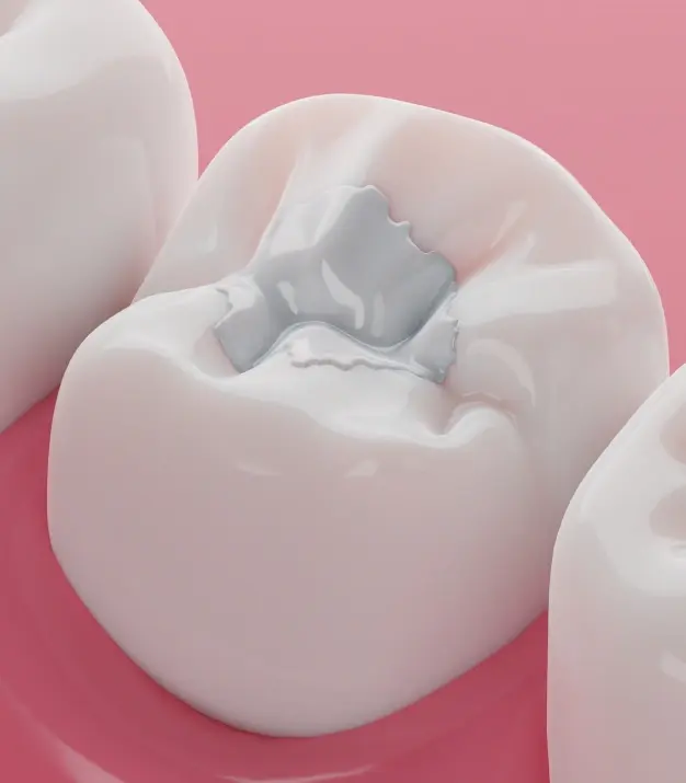 Tooth-colored dental filling illustration showing restoration in a natural white tooth on pink background.